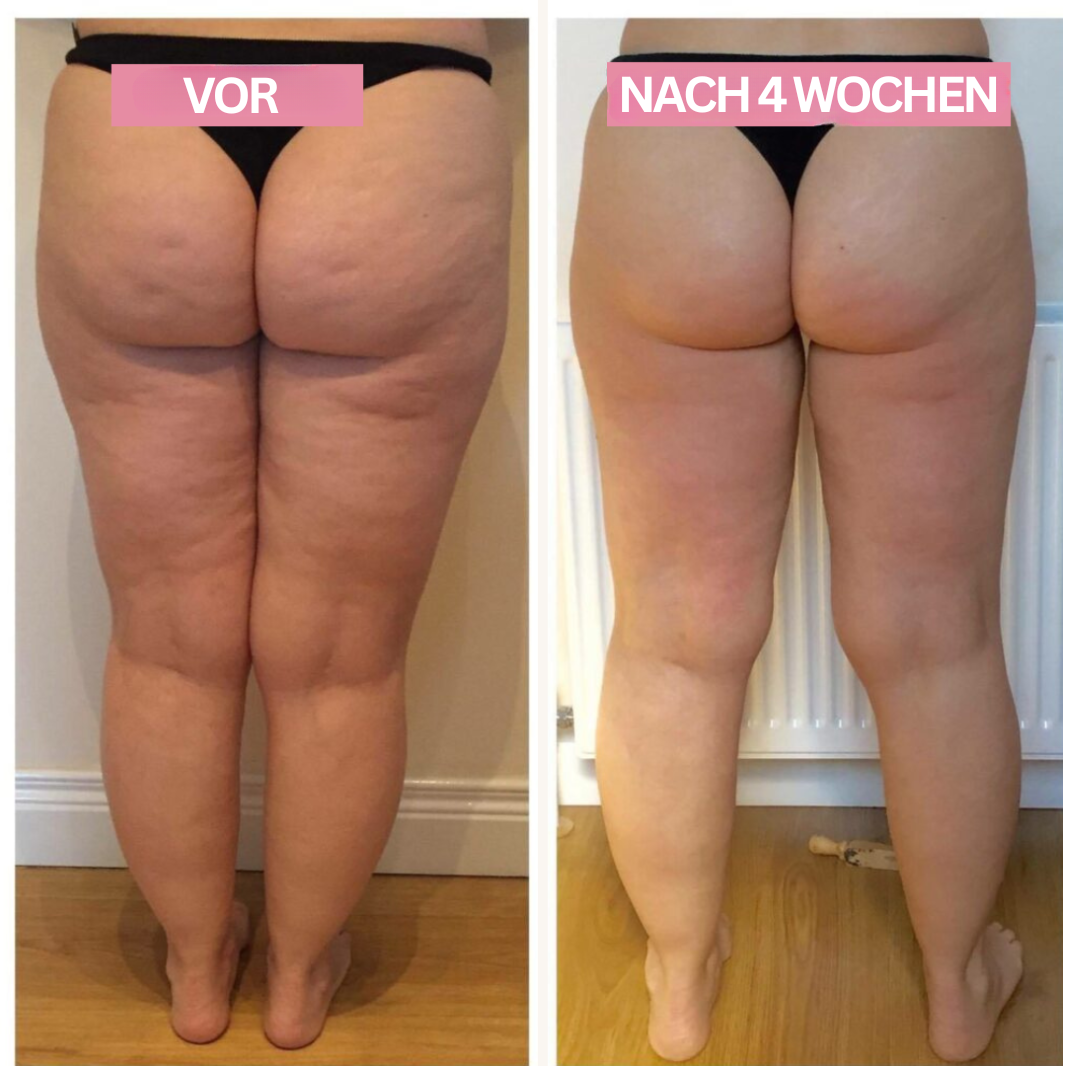 Cupping-Gerät | Anti-Cellulite Kompakt Vielseitig Effektiv USB-Luzern Mode