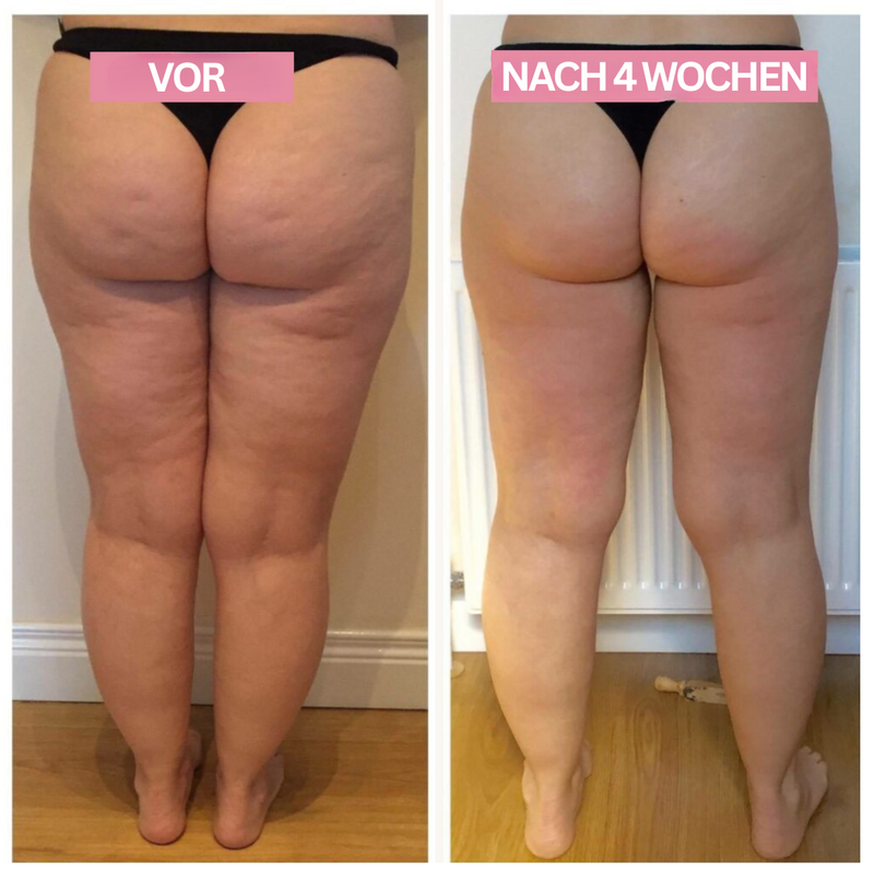 Cupping-Gerät | Anti-Cellulite Kompakt Vielseitig Effektiv USB-Luzern Mode