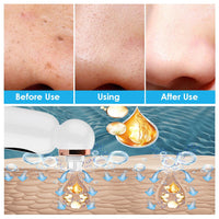 Mitesser Entferner | Hydrodermabrasion Hautpflege Gesicht-Luzern Mode