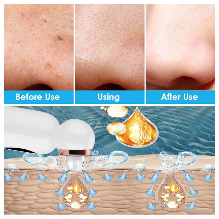 Mitesser Entferner | Hydrodermabrasion Hautpflege Gesicht-Luzern Mode